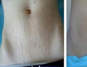 How to get rid of stretch marks on the stomach after childbirth at home