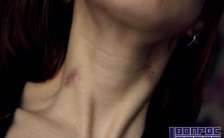 Tell-tale bruises, or how to remove hickeys in a matter of hours
