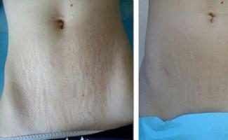 How to get rid of stretch marks on the stomach after childbirth at home